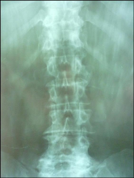 THE X ray of the thoracic and lumbar colonna-anterior