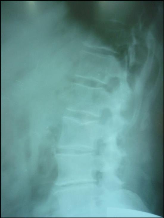 THE X ray of the lumbar colonna lateral incidence The