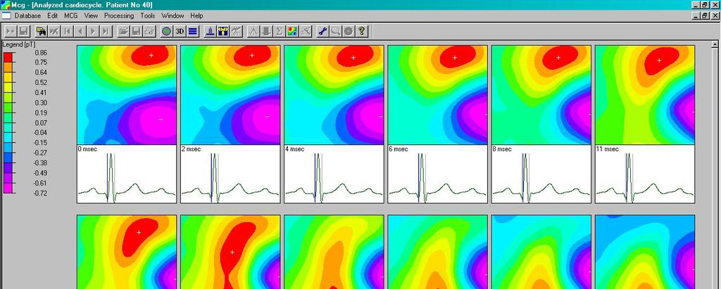 Magnetic Field Maps Since MCG data are acquired at a frequency of 1 khz, there are 1000 maps for every cardiac cycle.