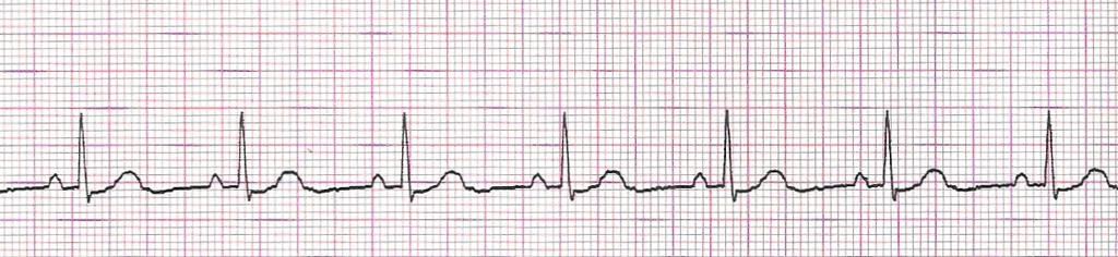Rhythm review 11 The various dysrhythmias you are responsible for will be reviewed in this section, but first, a review of normal sinus rhythm.