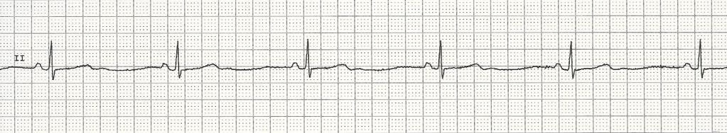 13 Sinus Bradycardia Rhythm Rate PR interval QRS P-P and R-R intervals regular less than 60 bpm positive, one precedes each QRS, same shape and size normal and constant beat to beat normal Nursing