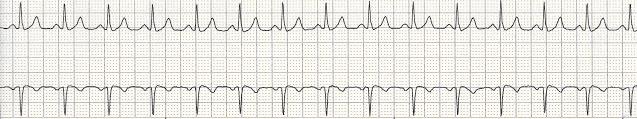 Sinus Tachycardia 15 Rhythm Rate PR interval QRS P-P and R-R intervals regular 101-180 bpm positive, one precedes each QRS, same shape and size normal and constant beat to beat normal Nursing Mgmt