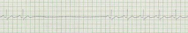 Sinus Arrest 16 Rhythm Rate PR interval QRS the basic rhythm is regular. The length of the pause is not a multiple of the sinus interval.
