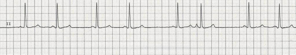 Premature Atrial Complex 19 Rhythm Rate PR interval QRS regular with premature beats; PAC's occur early in the cycle and they usually do not have a complete compensatory pause normal but depends on