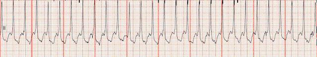 Atrial Tachycardia 21 Rhythm Rate PR interval QRS regular 150-250 bpm for each QRS but differ in shape from sinus s may be shorter or longer than normal normal Nursing Mgmt Medical Mgmt stimulants