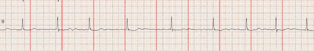 Atrial Fibrillation 23 Rhythm Rate PR interval QRS ventricular rhythm is usually irregularly irregular atrial rate usually between 400-600 bpm.
