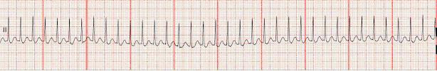 Supraventricular Tachycardia 24 Rhythm Rate PR interval QRS regular greater than 150 bpm not visible usually not measurable normal Nursing Mgmt Medical Mgmt CAD, HF, thyroid disease, COPD,