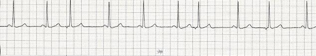 Premature Junctional Complex 26 Rhythm Rate PR interval QRS regular with premature beats normal or accelerated.