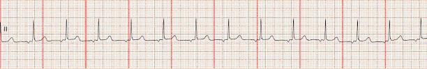 Accelerated Junctional 28 Rhythm Rate PR interval QRS very regular 61-100 bpm occur before, during or after the QRS depending on where the pacemaker is located in the AV junction.