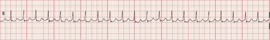 Junctional Tachycardia 29 Rhythm Rate PR interval QRS very regular 101-180 bpm occur before, during or after the QRS depending on where the pacemaker is located in the AV junction.