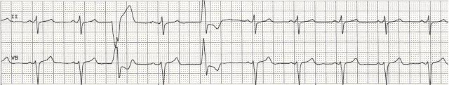 Premature Ventricular Complex 31 Rhythm Rate PR interval QRS essentially regular with premature beats; PVC's may occur in singles, couplets or triplets; or in bigeminy, trigeminy or quadrigeminy
