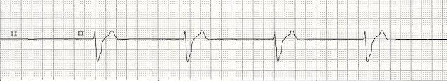 rhythm; 20-40 bpm for idioventricular rhythm usually absent or with retrograde conduction none as