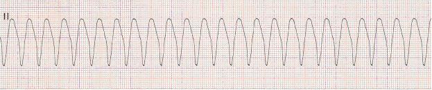 Ventricular Tachycardia Monomorphic VT Monomorphic VT : Ventricular tachycardia is called monomorphic VT when the QRS complexes are the same shape and amplitude 35 Rhythm Rate PR interval QRS three
