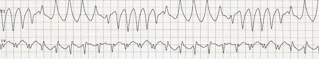 36 Polymorphic VT: When the QRS complexes vary in shape and amplitude from beat to beat the rhythm is polymorphic VT.