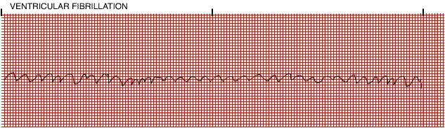 Ventricular Fibrillation 37 Rhythm Rate PR interval QRS chaotic electrical activity with no pattern or regularity unattainable not discernible not discernible not discernible Nursing Mgmt Medical