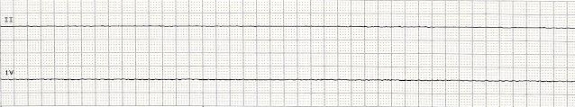 Asystole/Ventricular Standstill 38 Rhythm Rate PR interval QRS ventricular not discernible no ventricular activity but atrial activity may be seen may be seen, but there is no ventricular response
