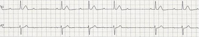 Second Degree AV Block Type I 41 Rhythm Rate PR interval QRS atrial regular, ventricular irregular atrial rate is greater than the ventricular rate normal; constant P-P interval; some s not followed