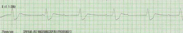 Third Degree or Complete AV Block 43 Rhythm Rate PR interval QRS atrial regular, ventricular regular but no relationship between the rhythms atrial rate is usually normal; ventricular rate is