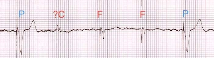 Paced Rhythms 44 Some indications for pacing include: sinus bradycardia sinus arrest sinus exit block atrial flutter or fib sick sinus syndrome chronotropic incompetence (SA node incapable of