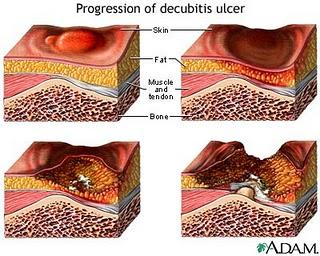 Stages of Pressure Ulcers Pressure ulcers are graded in stages I-IV, getting progressively worse with each stage Stage I: skin redness or discoloration, warmth, edema, hardness Stage II: skin and