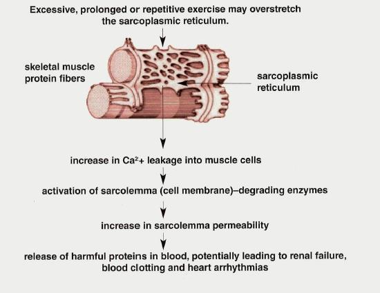 Pathophysiology Breakdown and necrosis of striated skeletal muscle after engaging in physical activity Necrosis
