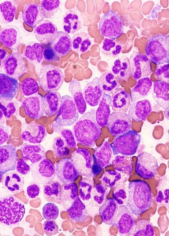 Bone Marrow Hypercellular with high M:E ratio due to increased granulopoiesis (resembles CML); blasts usually <5% Typical morphologic dissociation between a