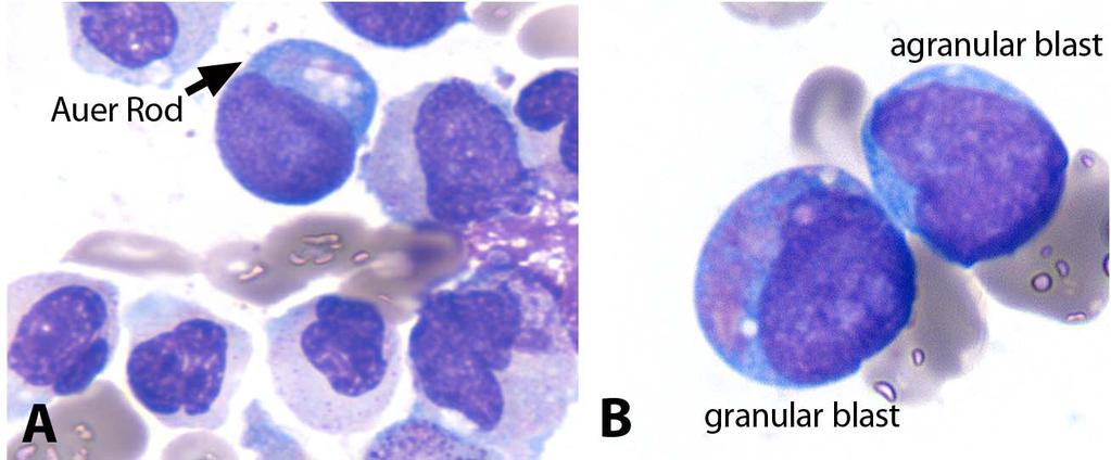 Blasts in MDS 1. Count 500 cells on BM aspirate smears, and 200 cells on peripheral blood smears 2. Myeloblasts: granular and agranular type 3.