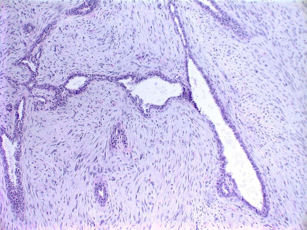 Fibroepithelial Lesions on CNB Dx of fibroadenoma