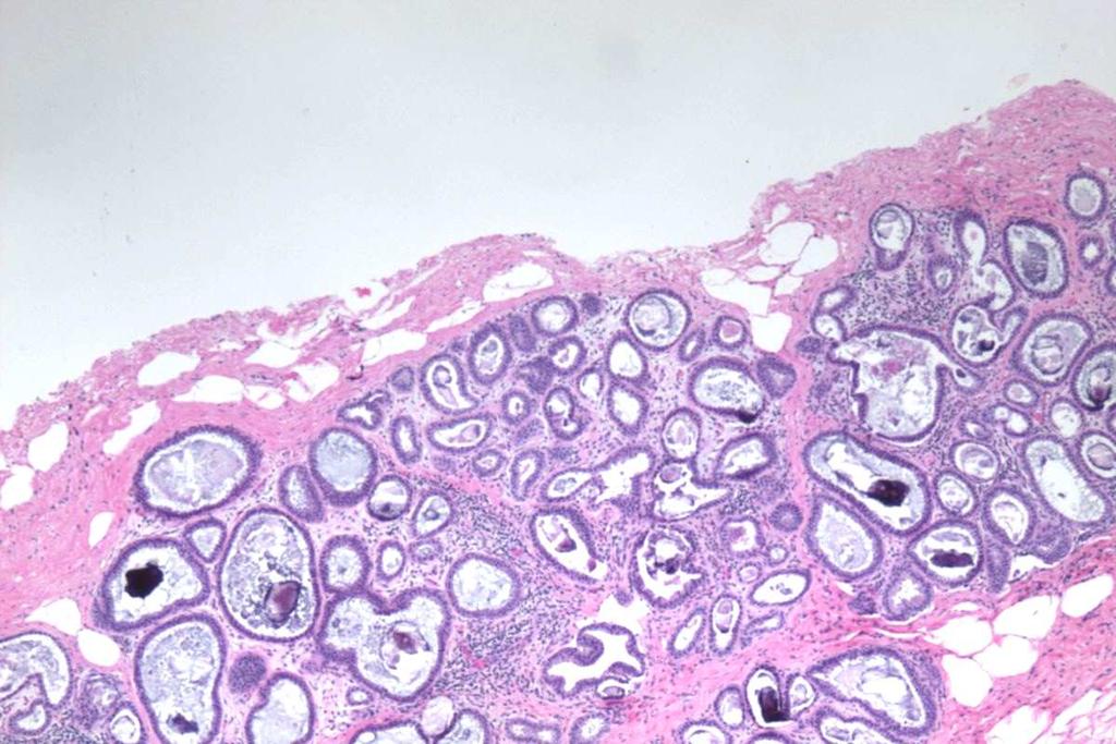 Flat Epithelial Atypia FEA on core