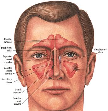 Sinuses Normally Air filled (cuts down weight of skull), lined w/upper respiratory epithelium Keeps antigens/infection