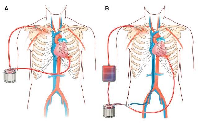 Novel minimally invasive surgical approach using an external ventricular assist device and extracorporeal membrane oxygenation in refractory cardiogenic shock 25 pts in CS ADHG (52%) AMI (48%)