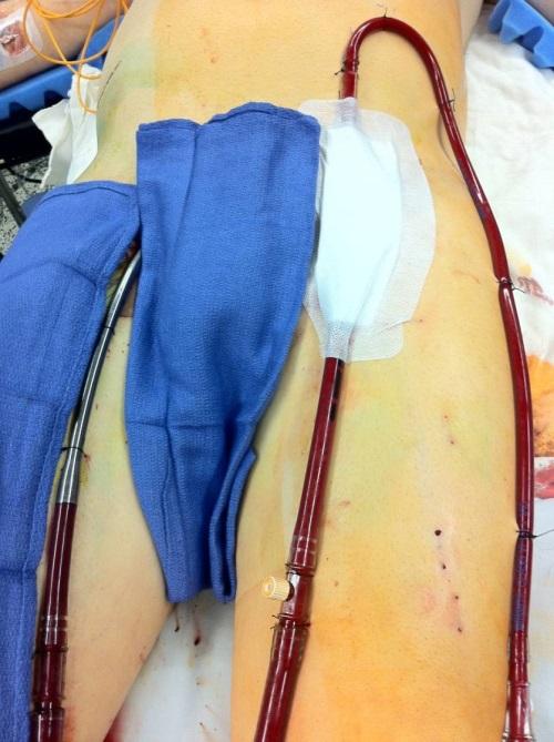 Percutaneous Technique and Distal Leg Perfusion on VA ECMO to minimize vascular