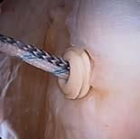 bridge Reduce bone abrasion leading to suture breakage Made from radiolucent PEEK-OPTIMA material