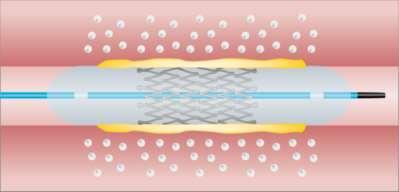 BARE-METAL STENTS play a role as definitive or adjunctive treatment options SFA stents are proven as a standalone therapy STUDY DEVICE Av. Lesion Length. PP FTLR 4EVER 1 Pulsar-18 10.8 cm 73.4% 85.