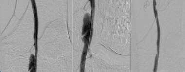 LifeStent Pulsar BMS Astron Pulsar Current Practice Could low-cof, thin strut stents be a good match for DCB?