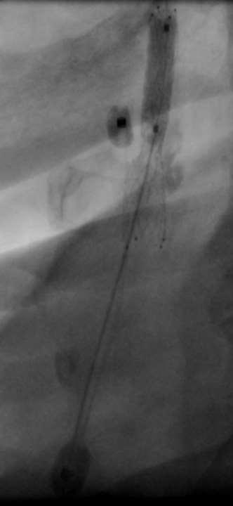 Angiography after stent MER implantation Large plaque