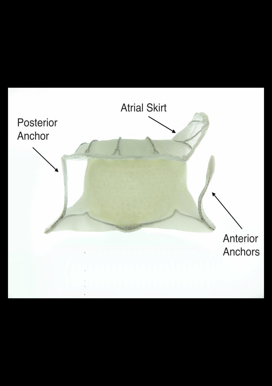 Anatomically shaped (Dshaped) Nitinol based,