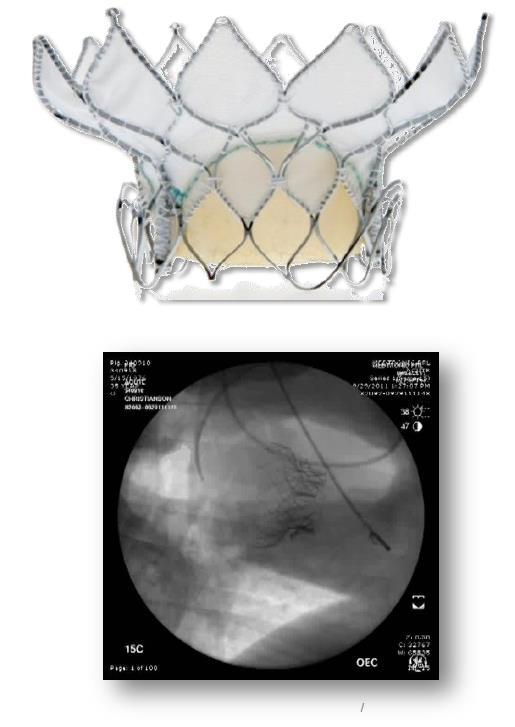 Medtronic TMVR Program Self expanding Nitinol Fixation with the native mitral apparatus Preserves native mitral apparatus