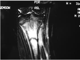 stress fracture Linear tenderness posterior medial tibial stress syndrome Physical Exam