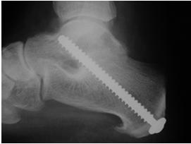 Reconstruction calcaneal osteotomy tendon transfer subtalar arthrodesis ankle arthrodesis Motor Deficit Case 1 17 year old HS