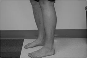 evaluation Foot drop Dorsal foot numbness Office compartment measurements at rest Ant and lat 30 mm Sup and Deep post 12 mm 2