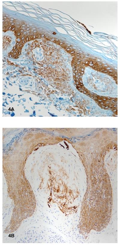 (Immunohistochemistry 200 magnification) Immunohistochemical staining for CK5/6 was positive in all of the reviewed