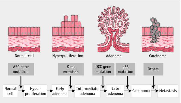 ! Carcinogenesis!! Carcinogenesis is a multistep process in cancer development.! It results from accumulation of genetic defects.