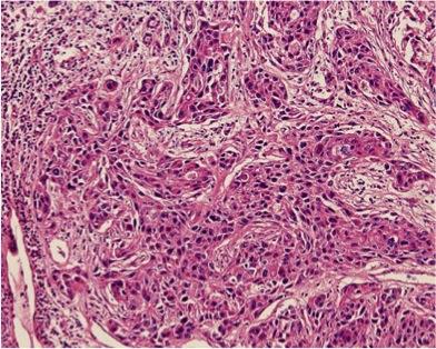 Poorly differentiated or undifferentiated tumors This anaplasia is marked by a number of morphologic and