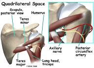 Introduction Quadrilateral space syndrome (QSS) happens when the axillary nerve is compressed, or injured in the back of the shoulder.