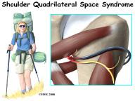 Quadrilateral space syndrome usually happens from overuse, especially with overhead sports like throwing and swimming. The syndrome can also be caused by an injury, like a shoulder dislocation.