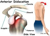The most common traumatic injury that causes quadrilateral space syndrome (QSS) is shoulder dislocation.