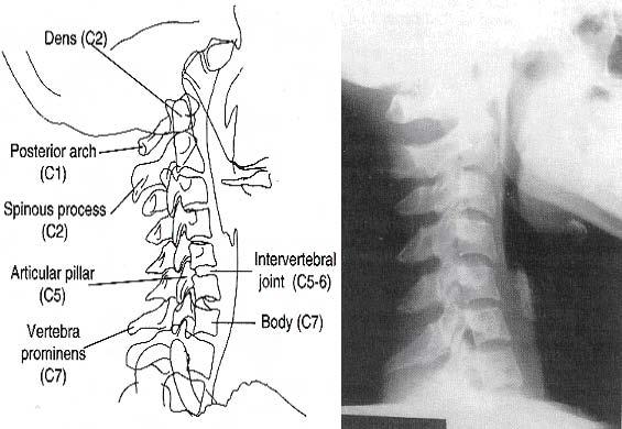 Section II. PROJECTIONS OF THE CERCICAL SPINE 4-3. LATERAL CERVICAL SPINE (C-SPINE) a. C-Spine Routine.