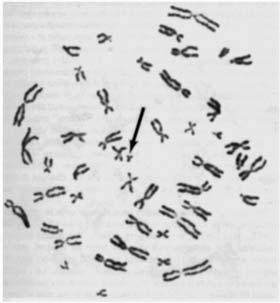 «Philadelphia chromosome» in chronic myeloïd leukemia (Nowell &