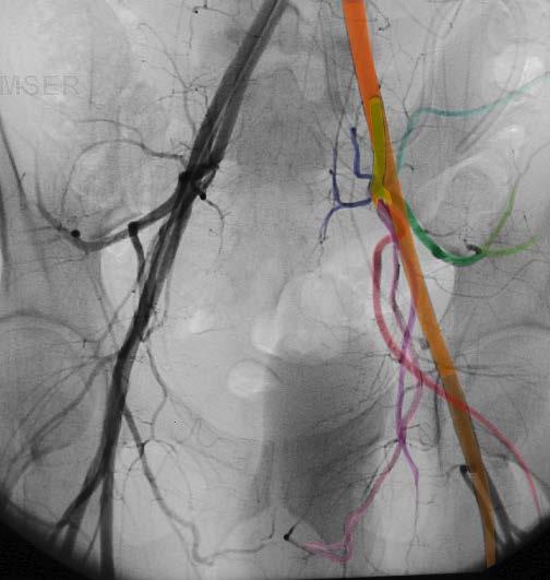 Pelvic Angiogram - Male Common iliac artery Internal iliac artery Lateral sacral artery Iliolumbar artery Posterior trunk of